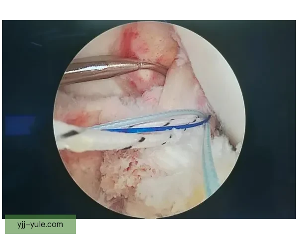 越南国奥中卫十字韧带伤退手术